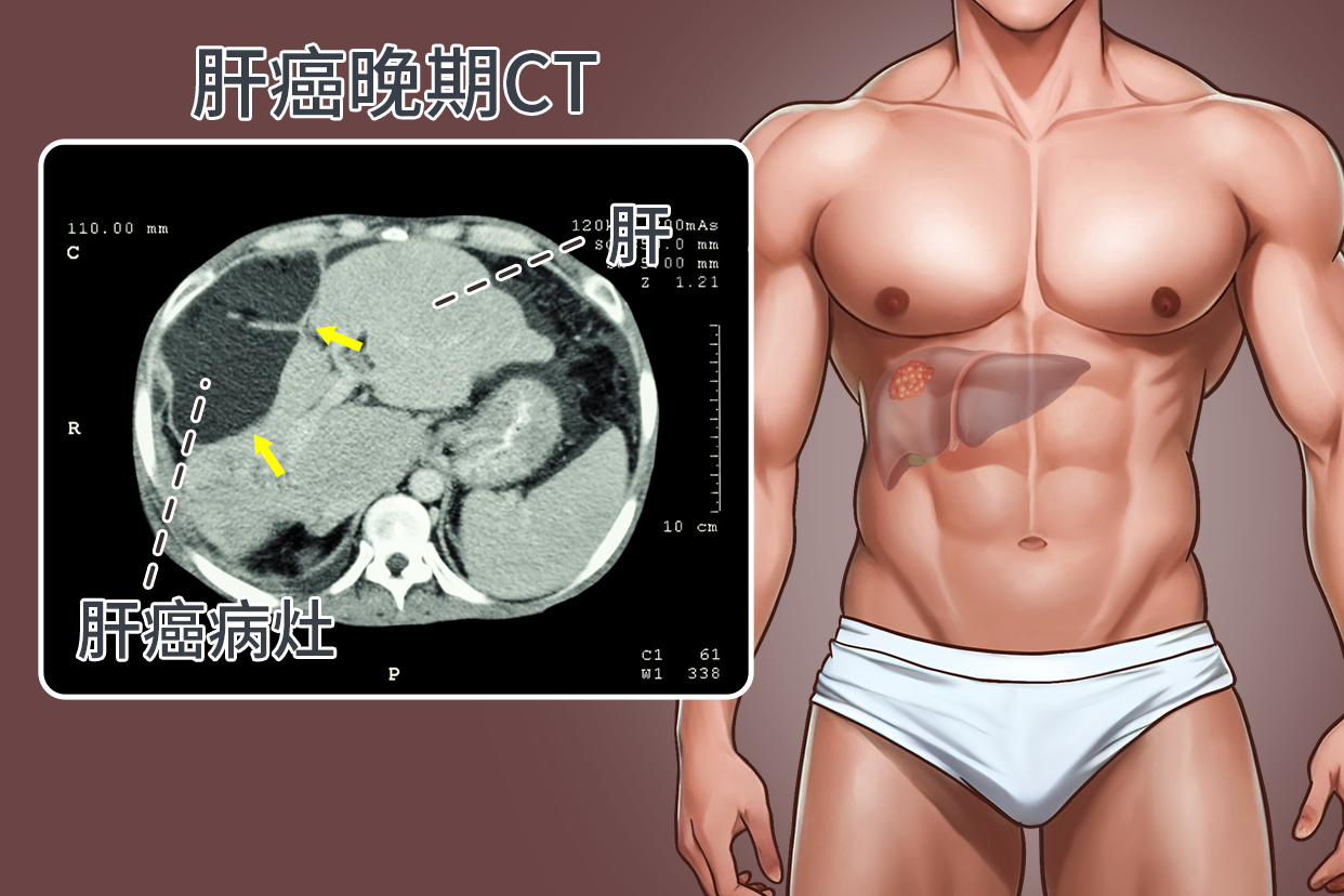 肝癌晚期CT图片