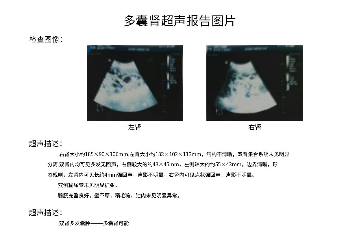 多囊肾超声报告图片