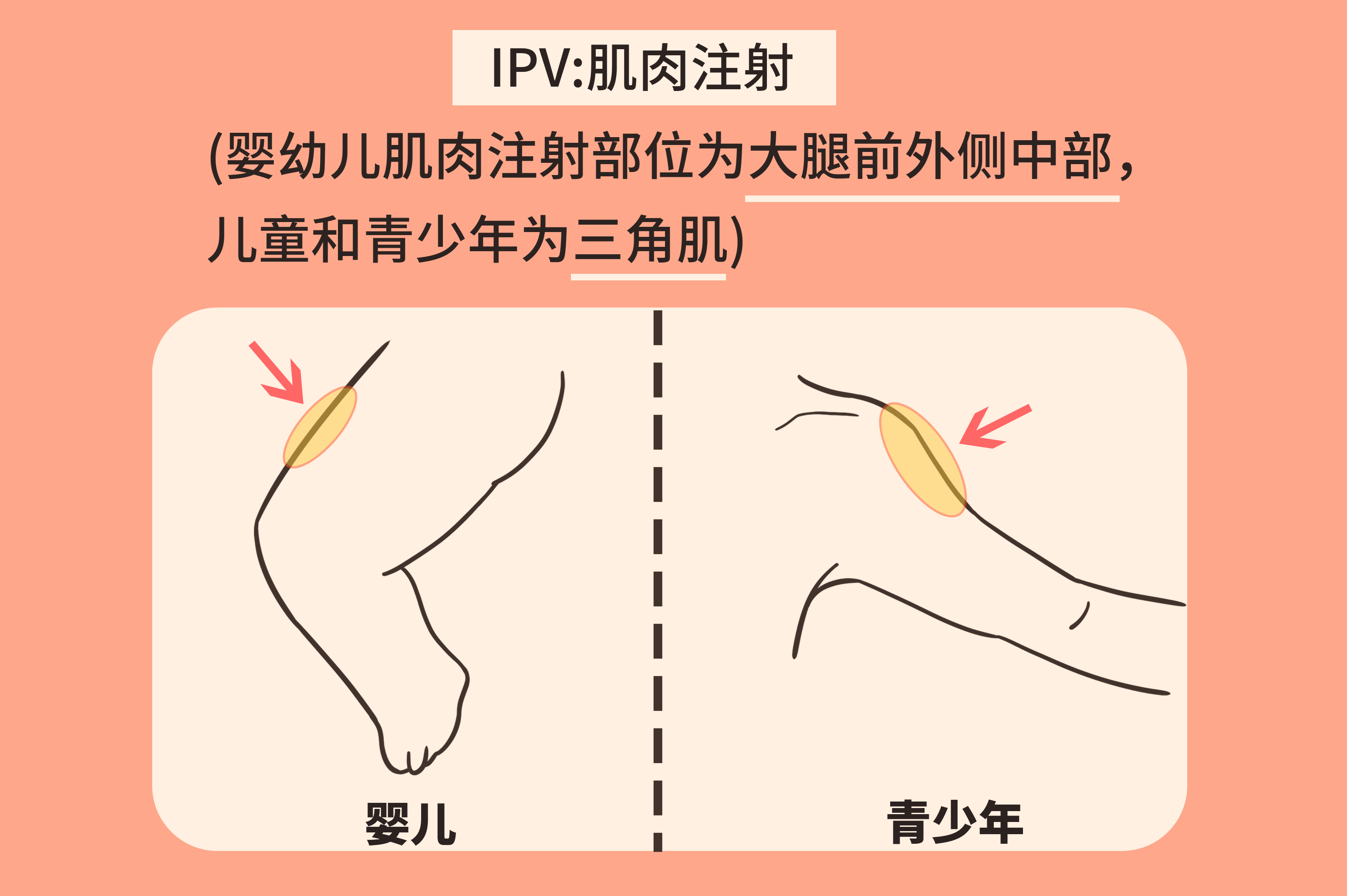 脊灰疫苗注射部位示意图