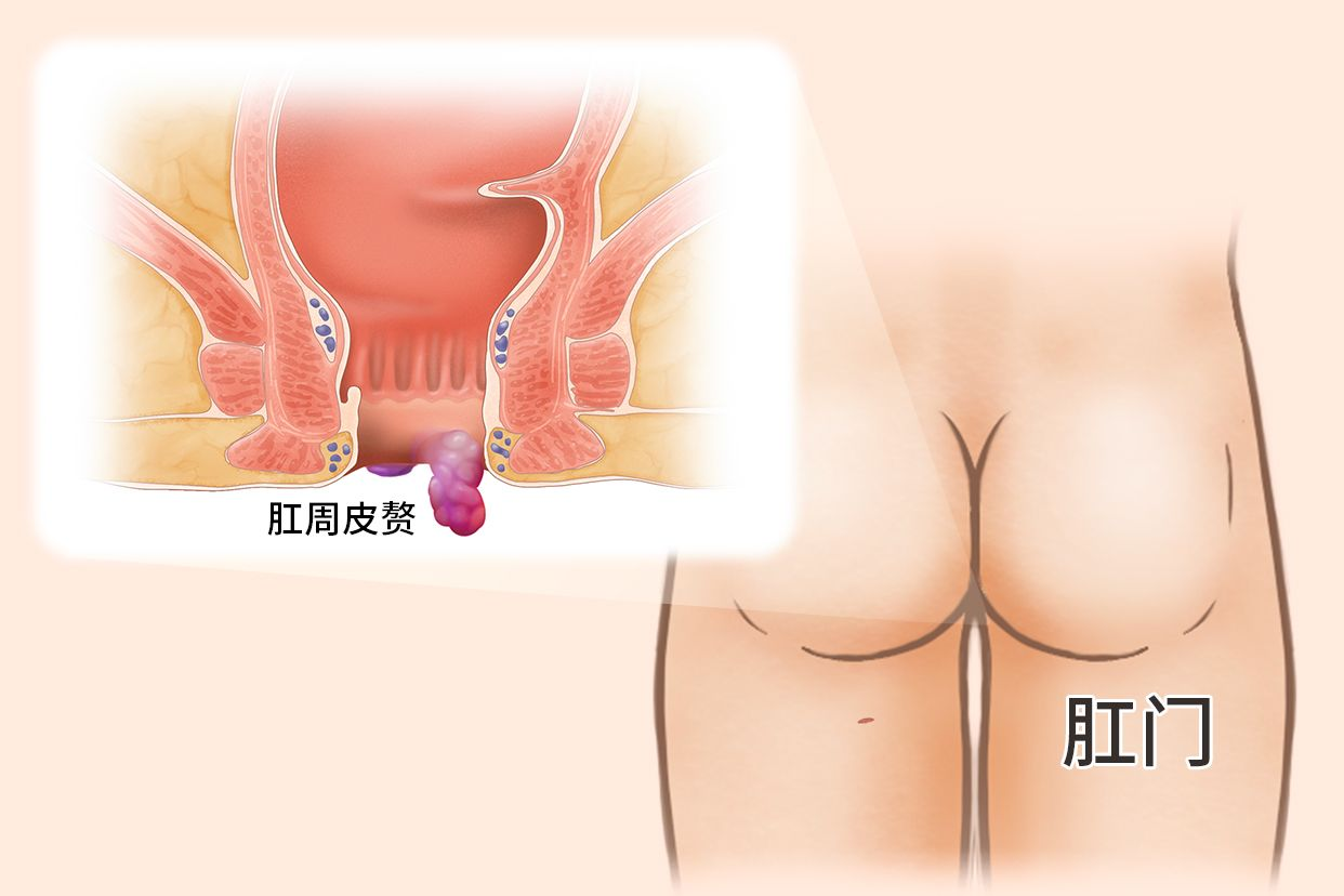 肛周皮赘图