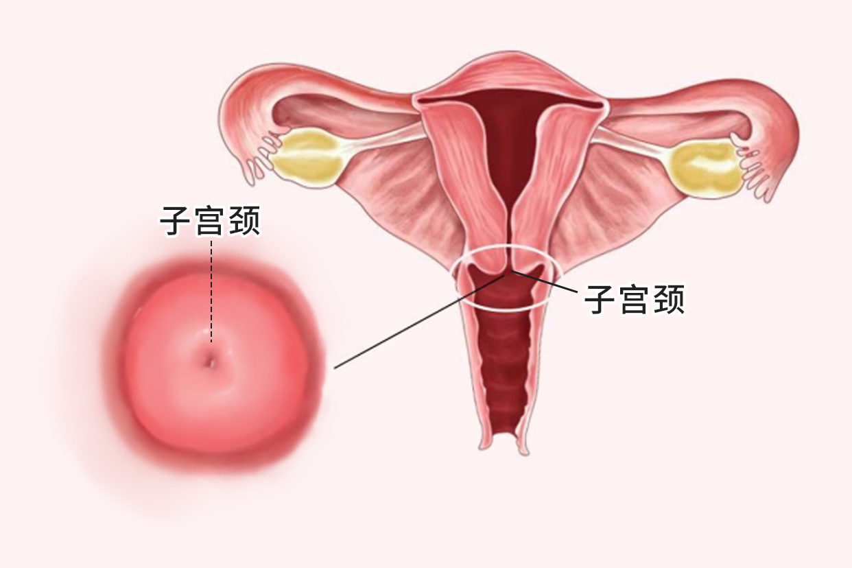 孕期宫颈息肉反复出血