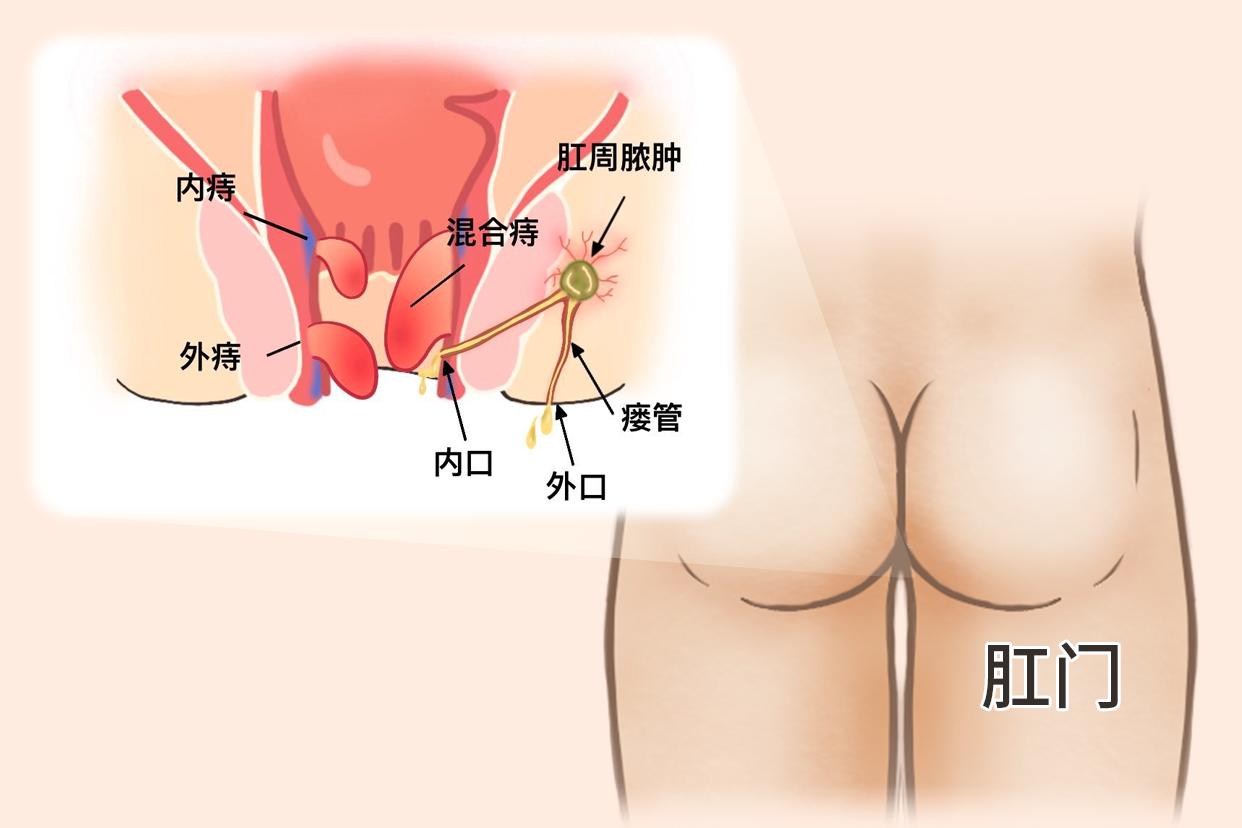 肛瘘图片