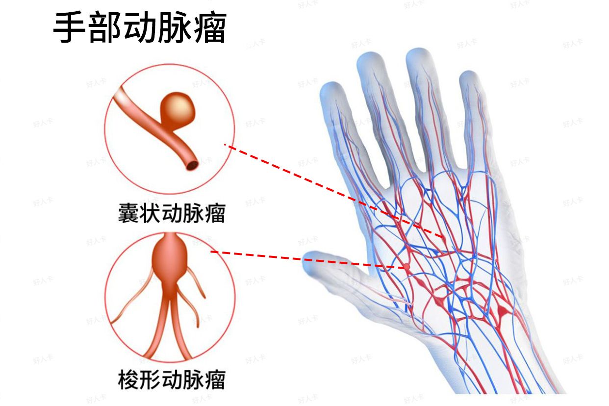 手部大动脉图片