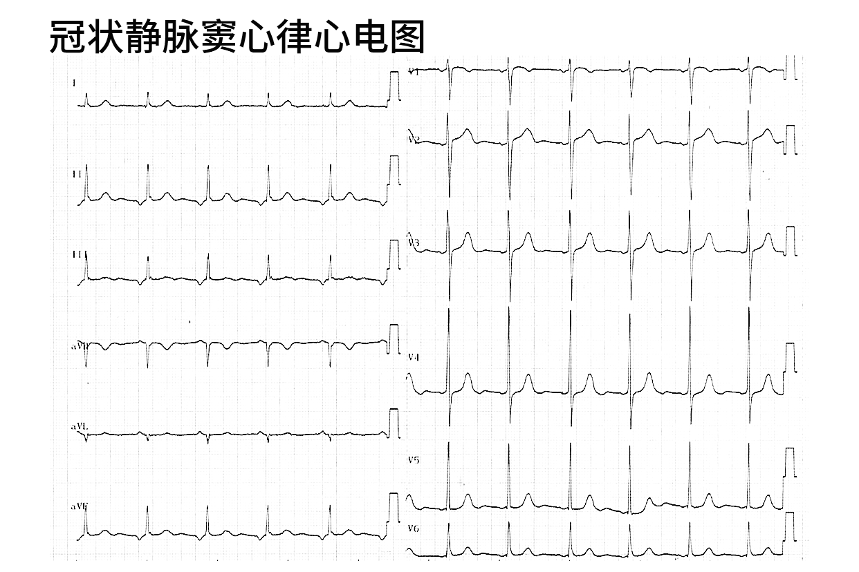 冠状静脉窦心律心电图