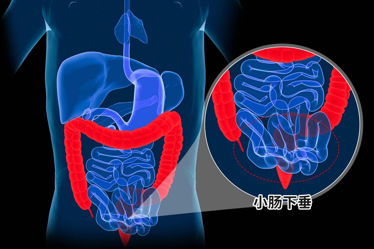 小肠下垂图片
